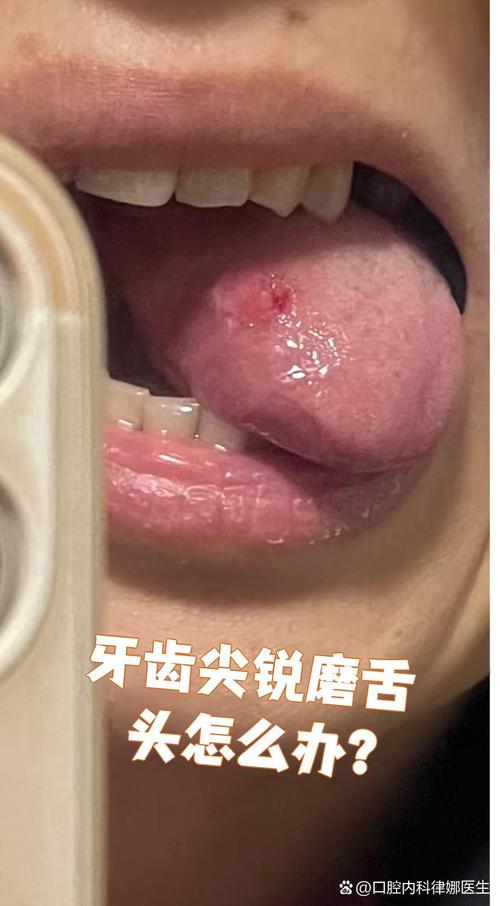 （舌根和牙龈被缝一起怎么办）